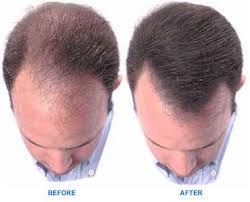 PRP hair therapy in Delhi, Results